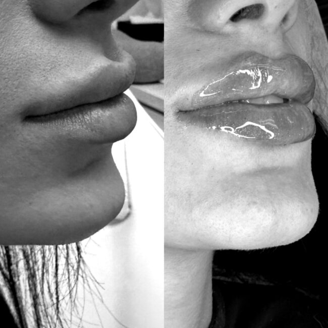injection